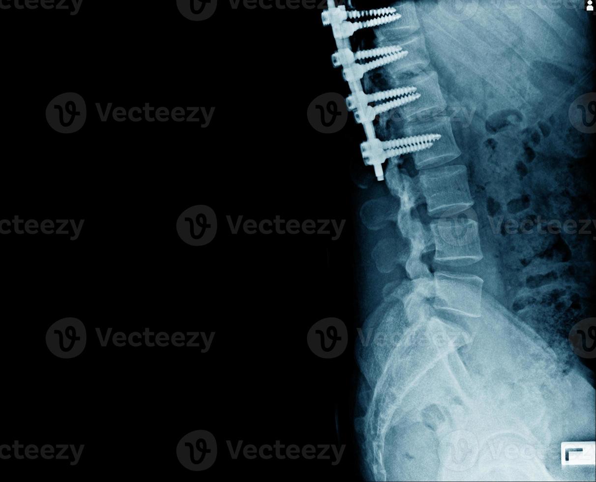 Seitenansicht des Strukturknochens mit interner Fixierung foto