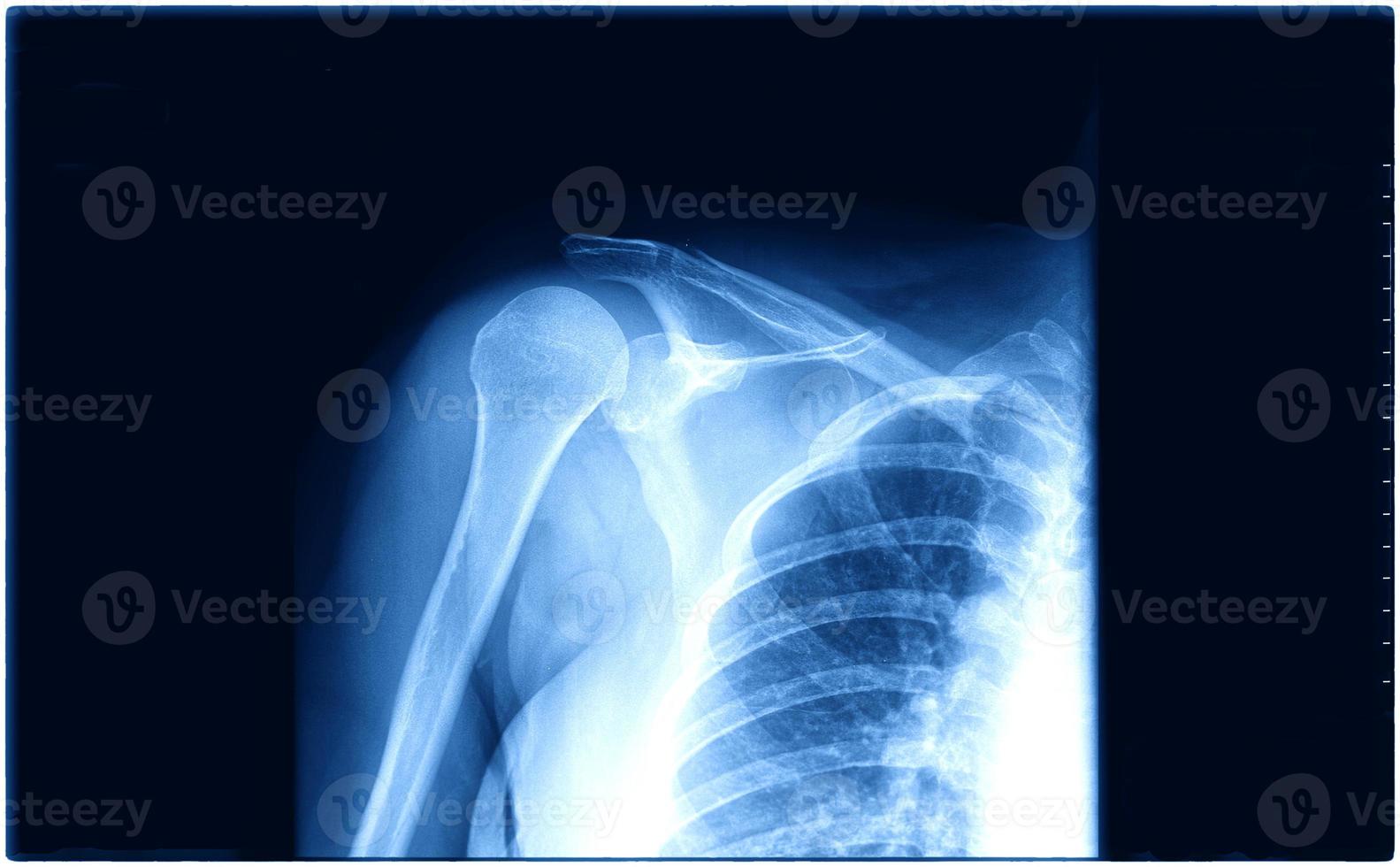 Röntgenbild der menschlichen Brust für eine medizinische Diagnose foto