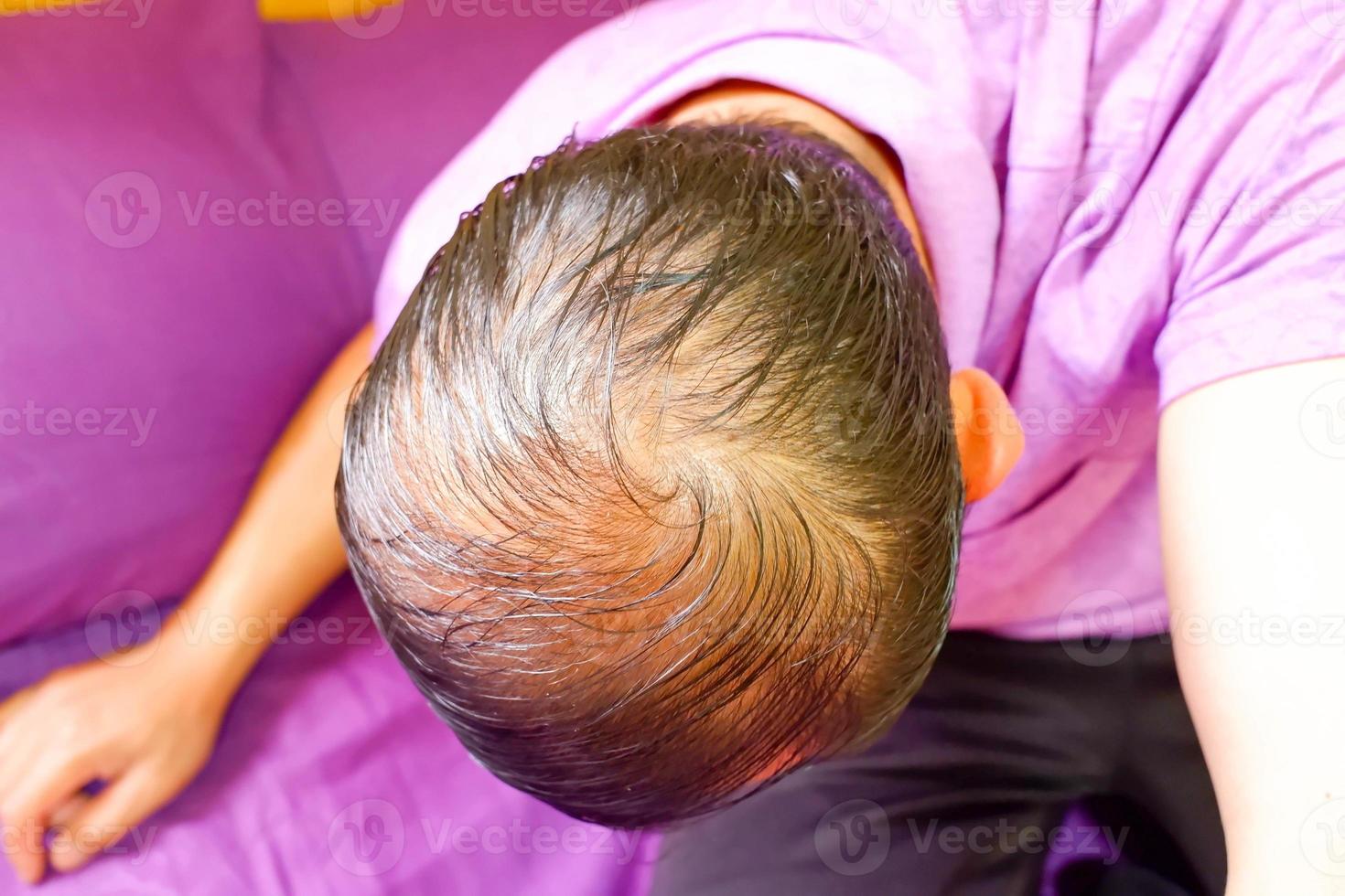 ein junger Mann ist Haarausfall. Glatze. haarausfall männer. foto