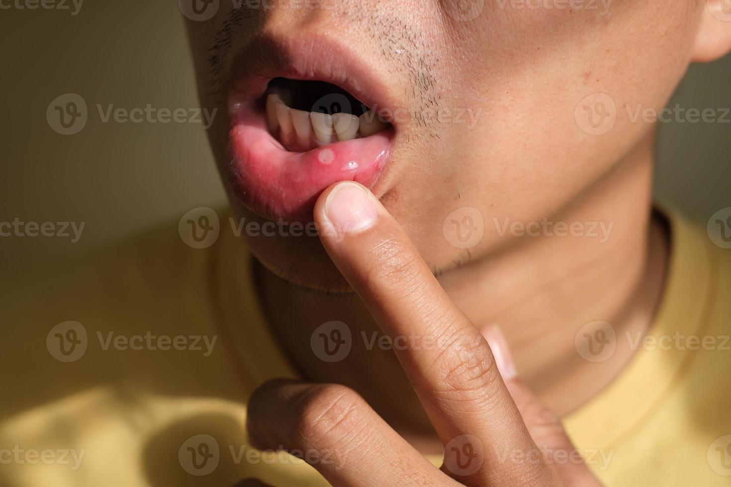 Nahaufnahme der Lippen des Mannes haben ein Geschwür im Mund. Stomatitis an der Lippe. Gesundheitsproblemkonzept. foto
