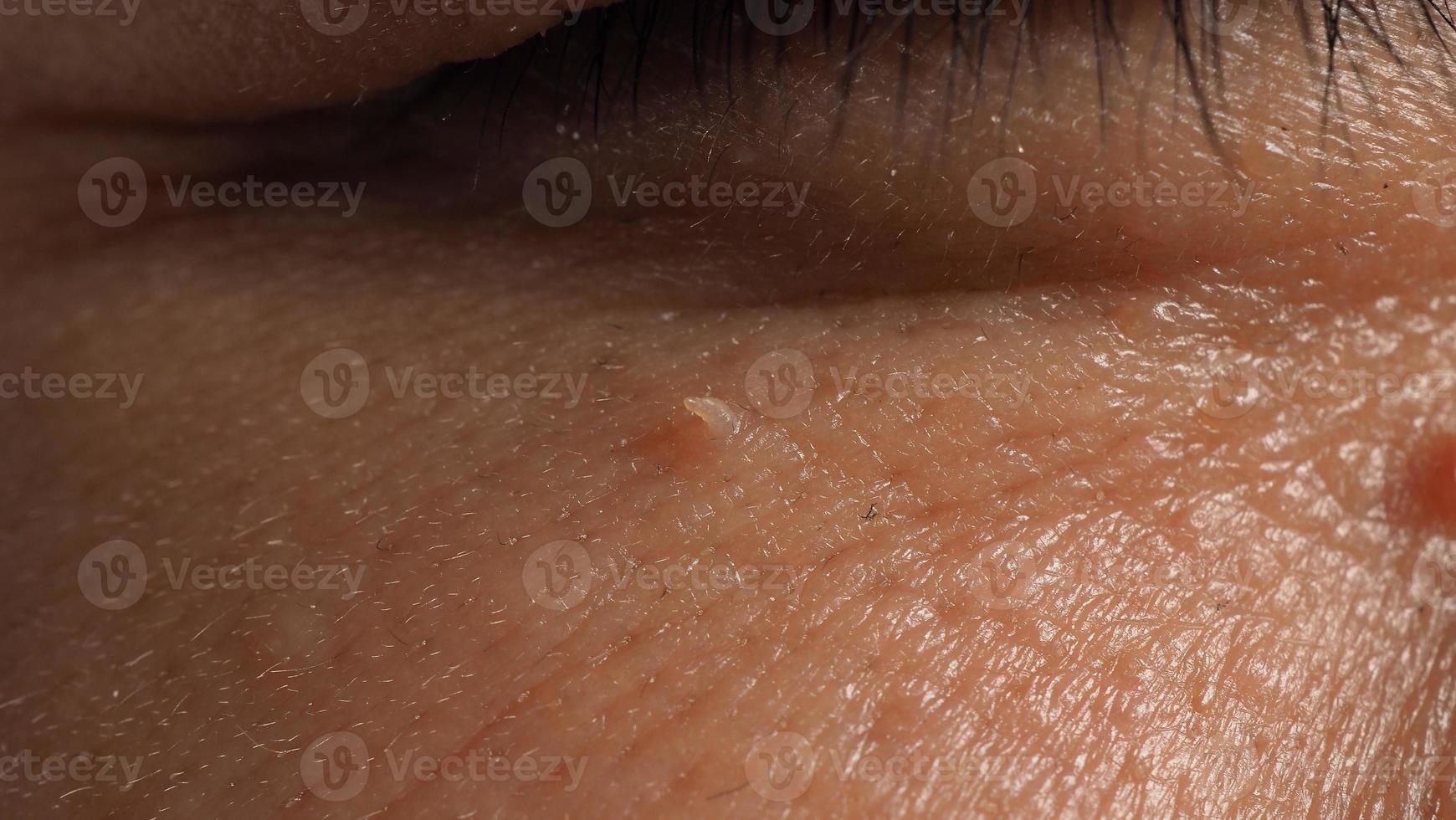 Entfernung der Warzenhaut. Makroaufnahme von Warzen in der Nähe des Auges im Gesicht. foto