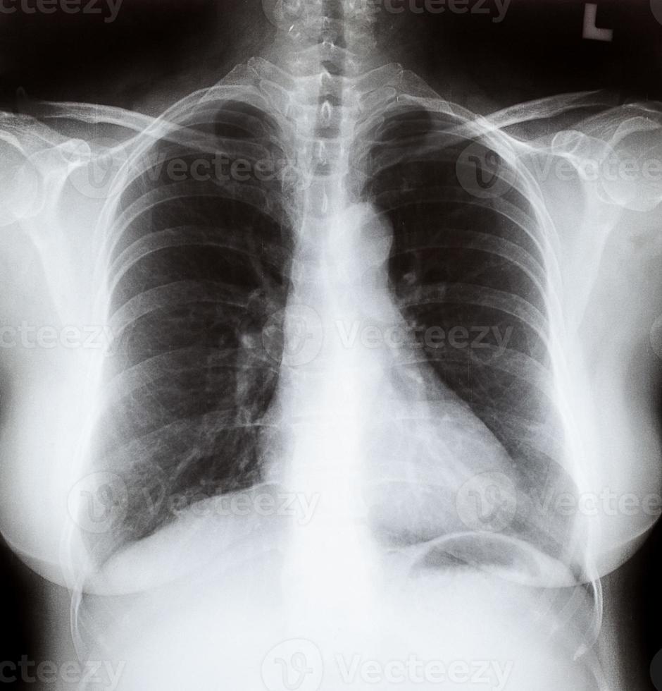 Röntgenbild der Frauenbrust foto
