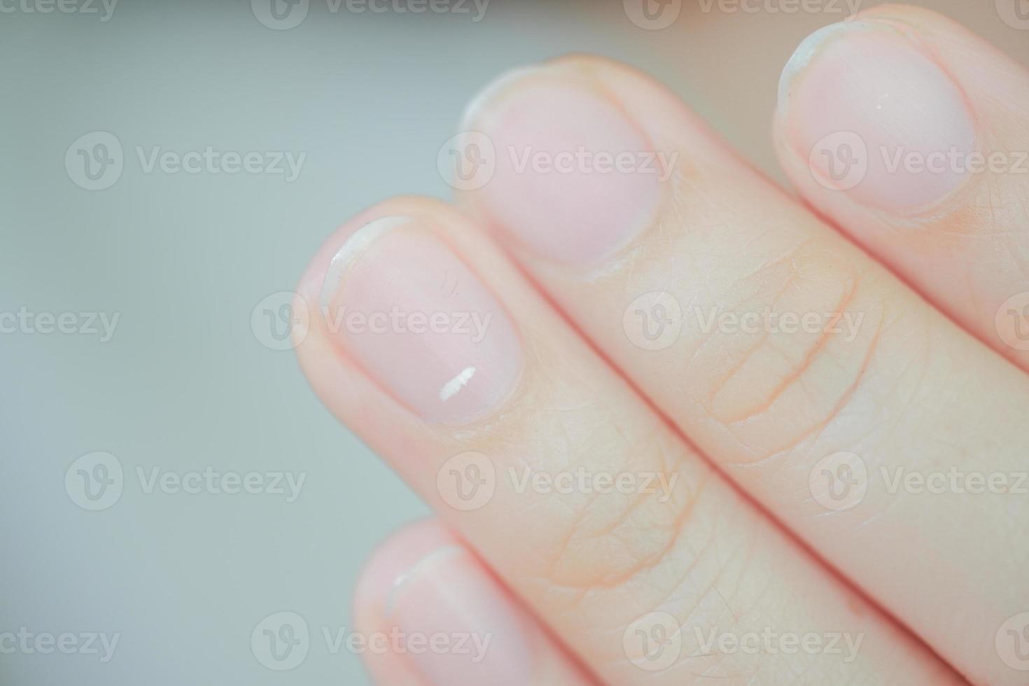 Weiße Flecken auf den Fingernägeln, Leukonychie genannt, weisen auf das Auftreten von Gesundheitsproblemen hin. foto