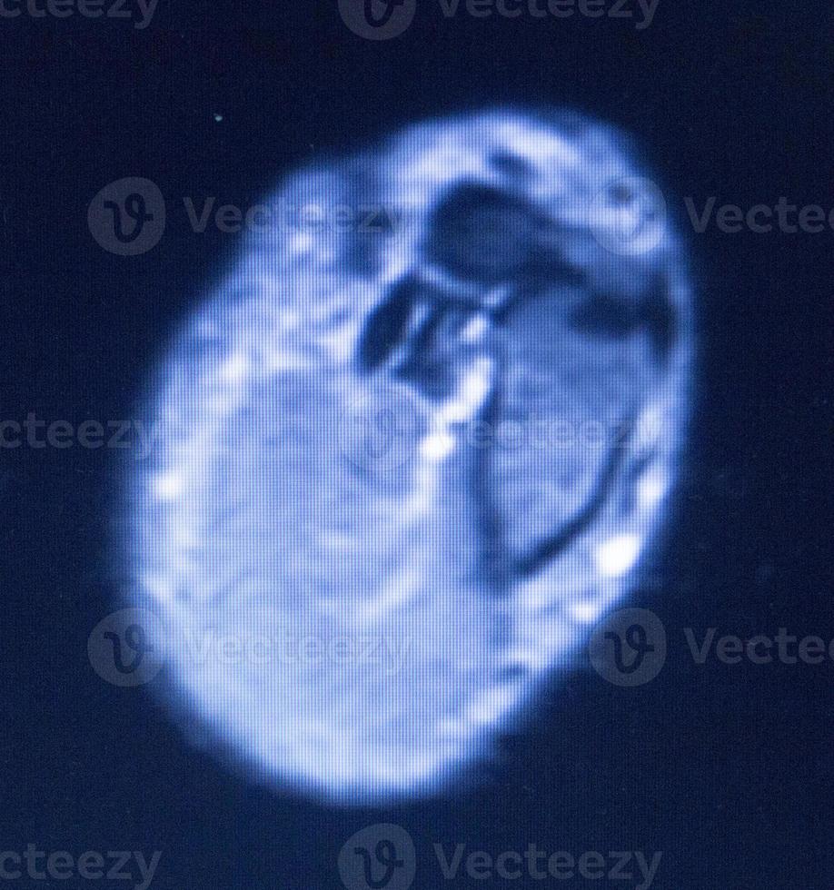 mri Magnetresonanztomographie Handfinger-Scan foto