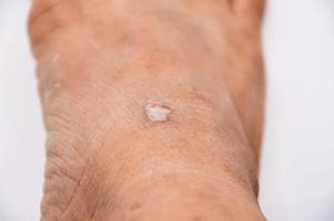 Red Foot Ulcus Entzündung der Wunde weißer Hintergrund Konzept Heilung foto