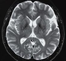mri der normalen Anatomie des menschlichen Gehirns foto