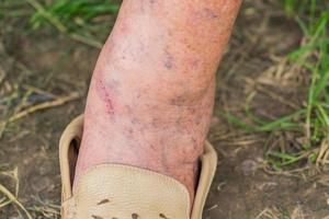 Verletztes Bein einer älteren Frau mit Krampfadern. foto