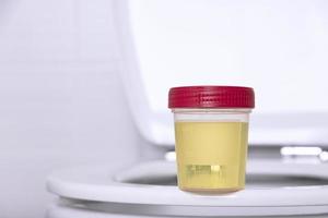 eine urinprobe in einem medizinischen behälter sitzt auf dem rand einer weißen haushaltstoilette. selektiver Fokus. foto
