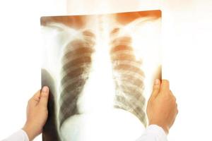 Beim Röntgen der Lunge werden Röntgenstrahlen in einen Teil des Brustkorbs oder der Lunge gerichtet, wo die Röntgenbilder auf Film aufgezeichnet werden foto