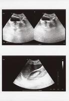 Ultraschall-Sonogramm des gesamten Abdomens foto