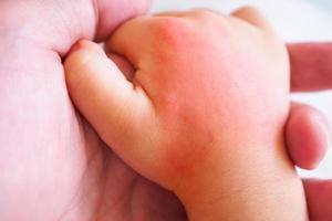 Babyhand mit Hautausschlag und Allergie mit rotem Fleck durch Mückenstich foto