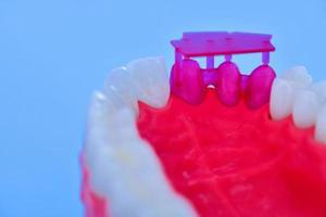 Zahnimplantat- und Kroneninstallationsprozess foto