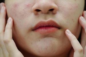 Akne Pickel und Narben auf der Haut, Störungen der Talgdrüsen, Schönheitsproblem bei der Hautpflege von Teenagern. foto