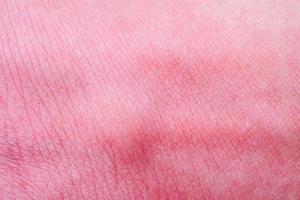 Hautallergie mit Hautausschlag nach Mückenstich foto