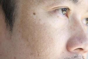 nahaufnahme asiatisches manngesicht mit sommersprossen dunkle flecken von uv-licht, hautpflege und gesundheitsproblemkonzept foto