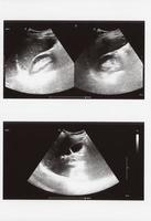Ultraschall-Sonogramm des gesamten Abdomens foto