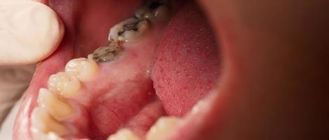 kariöse Zahnwurzelkanalbehandlung. Zahn oder Karies des unteren Backenzahns. foto