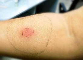 Mantoux-Impfung, Nahaufnahme des Patientenarms mit roter Fleckreaktion auf die Durchführung des Mantoux-Tests. positiver Tuberkulosepatient. foto