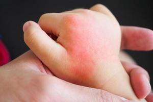 Babyhand mit Hautausschlag und Allergie mit rotem Fleck durch Mückenstich foto