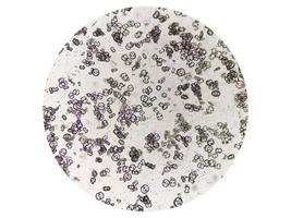 Mikroskopische Aufnahme von Calciumoxalatmonohydrat, Harnsäurekristallen und dreifachen Phosphatkristallen aus Urinsediment. uti. Nierenerkrankung. foto