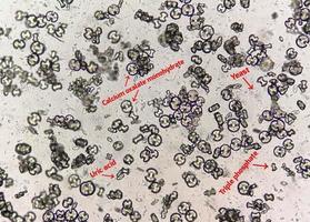Mikroskopische Aufnahme von Calciumoxalatmonohydrat, Harnsäurekristallen und dreifachen Phosphatkristallen aus Urinsediment. uti. Nierenerkrankung. foto
