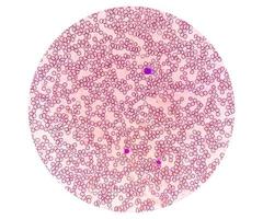 Mikroskopische Ansicht eines hämatologisch gefärbten Objektträgers. Thrombozytopenie. extrem niedriger Thrombozytenwert im Blut. foto