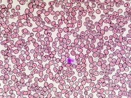 Mikroskopische Ansicht eines hämatologisch gefärbten Objektträgers. Thrombozytopenie. extrem niedriger Thrombozytenwert im Blut. foto