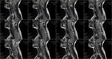Reihe sagittaler MRT-Scans des Halsbereichs eines 34-jährigen kaukasischen Mannes mit bilateraler paramedialer Extrusion des c6-c7-Segments mit Radikulopathie foto