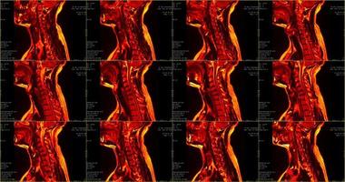 Satz von 12 sagittalen, rot gefärbten MRT-Scans des Halsbereichs eines kaukasischen 34-jährigen Mannes mit bilateraler paramedialer Extrusion des c6-c7-Segments foto