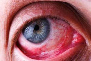 graues Auge eines kaukasischen Mannes mit rotem Kapillarnetz, unteres Augenlid zurückgezogen foto