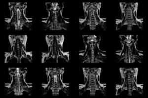 Reihe von koronalen MRT-Scans des Halsbereichs eines kaukasischen Mannes mit bilateraler paramedialer Extrusion des c6-c7-Segments mit Radikulopathie foto