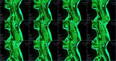 Satz von 6 sagittalen grün gefärbten MRT-Scans des Halsbereichs eines kaukasischen 34-jährigen Mannes mit bilateraler paramedialer Extrusion des c6-c7-Segments foto