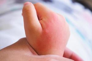 Babyhand mit Hautausschlag und Allergie mit rotem Fleck durch Mückenstich foto