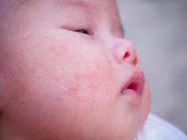 neugeborenes baby mit allergie im gesicht foto