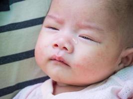 neugeborenes baby mit allergie im gesicht foto