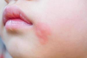 Hautausschlag und Allergie des kleinen asiatischen Mädchens mit rotem Fleck, verursacht durch Mückenstich im Gesicht foto
