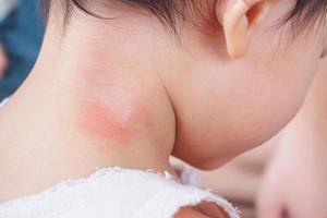 Babyhautausschlag und Allergie mit rotem Fleck, verursacht durch Mückenstich am Hals foto