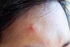 entzündliche Akne mit rotem Fleck im Gesicht, Nahaufnahme foto