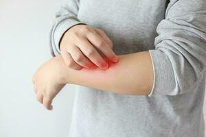junge asiatin juckt und kratzt am arm von juckender trockener hautekzem-dermatitis foto