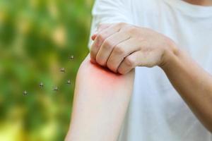 man juckt und kratzt am arm durch allergischen hautausschlag, der durch mückenstich verursacht wird foto