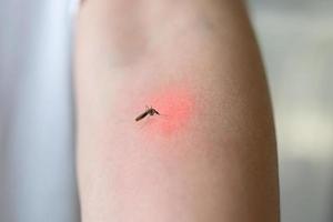 Mückenstich am Arm eines Erwachsenen mit Hautausschlag und Allergie mit rotem Fleck foto