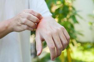 man juckt und kratzt an der hand durch allergischen hautausschlag, der durch insektenstich im freien verursacht wird foto