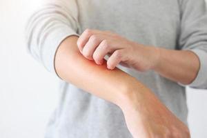 junger asiatischer mann juckt und kratzt am arm von juckender trockener hautekzem-dermatitis foto