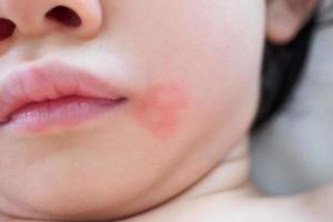 Hautausschlag und Allergie des kleinen asiatischen Mädchens mit rotem Fleck, verursacht durch Mückenstich im Gesicht foto
