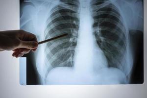 Röntgen der Lunge. Brust Röntgen. Sicht des Arztes auf das Lungenbild im Krankenhaus auf einer reflektierenden Tafel, unscharfer Fokus foto