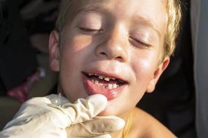 offener Mund eines Jungen mit falsch wachsenden Zähnen, Karies von Milchzähnen, entfernten Milchzähnen, Zahnheilkunde und Gesundheitswesen foto
