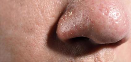 Akne und Problemporen. weiße und Mitesser-Pickel aus Nasenporen. foto