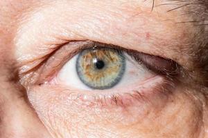 wundes Auge mit Verdickung am Augenlid von Chalazion foto