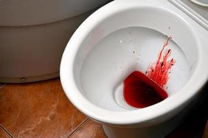 Eine Toilettenschüssel aus weißer Keramik ist mit Blut befleckt. die Folgen einer ausgeprägten Menstruation, Dysbakteriose, Ruhr, Hämorrhoiden, Krebs und andere Krankheiten mit ähnlichen Symptomen foto
