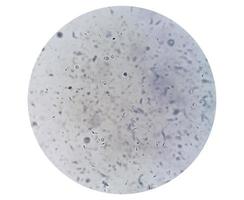 Samenanalyse unter dem Mikroskop, die eine Pyospermie oder Leukozytospermie zeigt. Spermienanalyse. foto